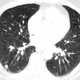 Illustration for article titled 83 Percent of Radiologists Didn't Spot the Gorilla Hiding in This CT Scan